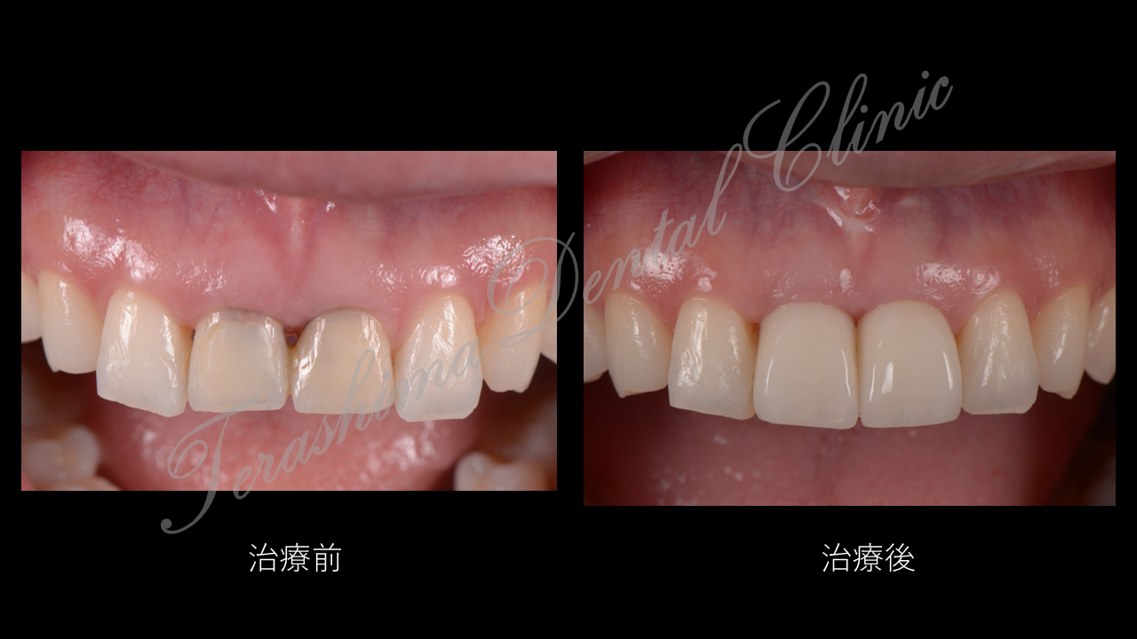 前歯のインプラント～ルートメンブレンテクニック～ | 箕面市の歯医者