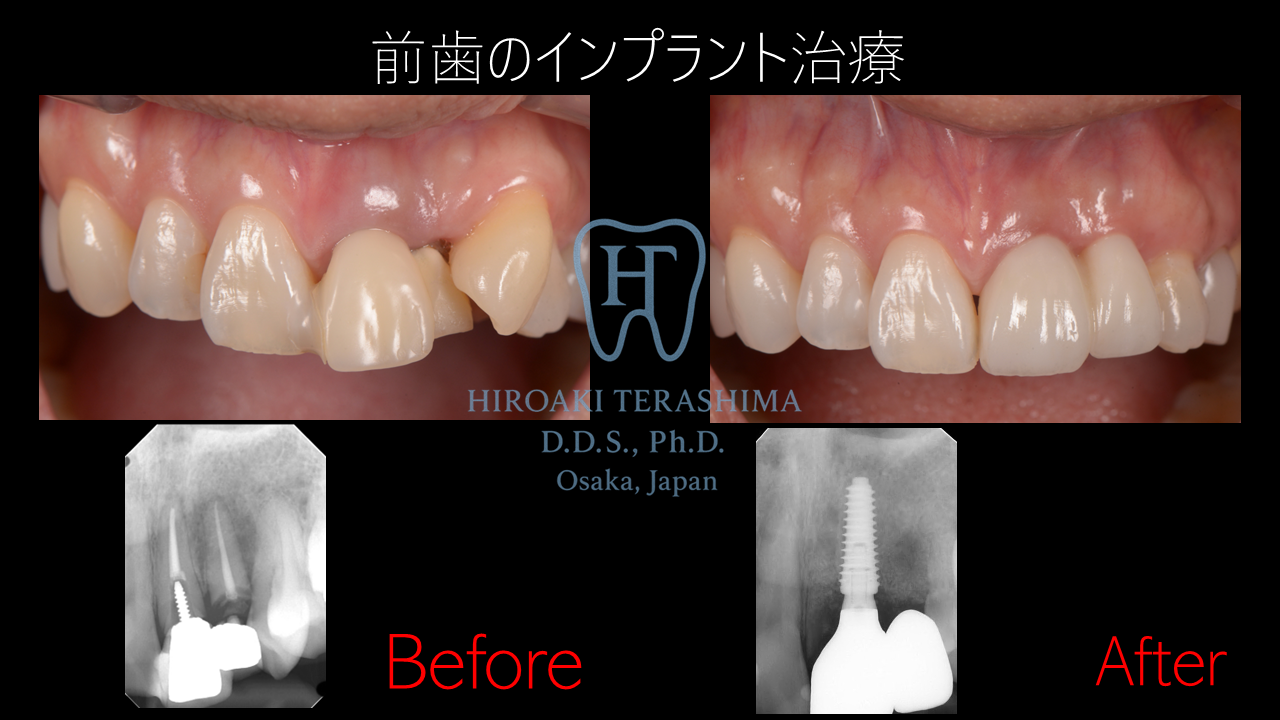 前歯のインプラント〜重度の歯列不正に対するシミュレーション主導の