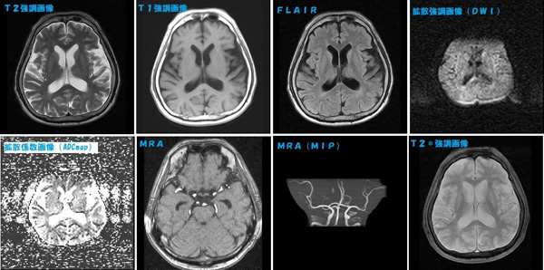 ちょっと気になる画像講座①～脳梗塞ってどこ見ればわかるの