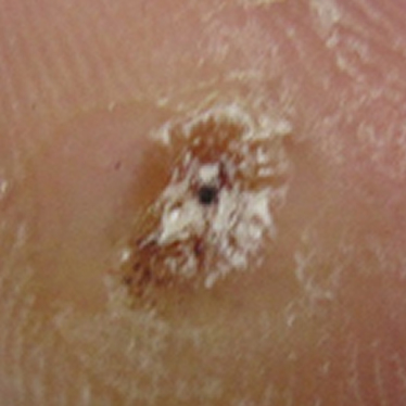 いぼの治療は三鷹はなふさ皮膚科へ | 粉瘤・ほくろ除去で皮膚科をお