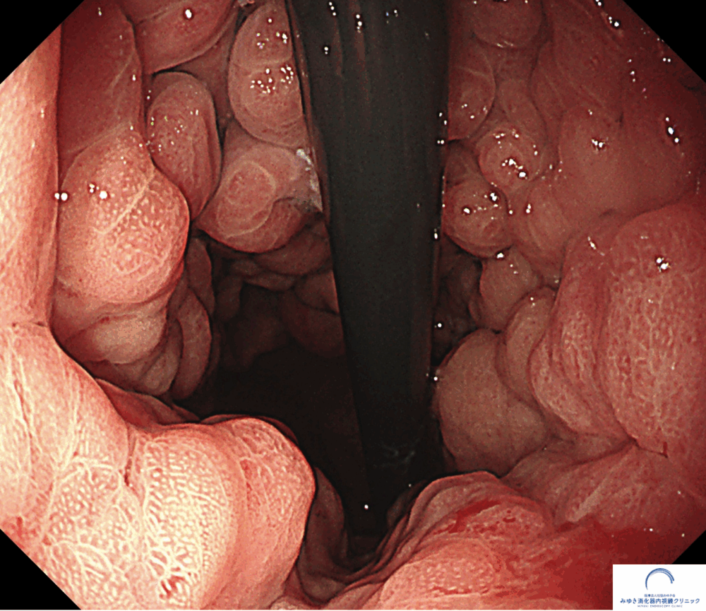 今月の1例：スキルス胃がん｜みゆき消化器内視鏡クリニック｜多摩市
