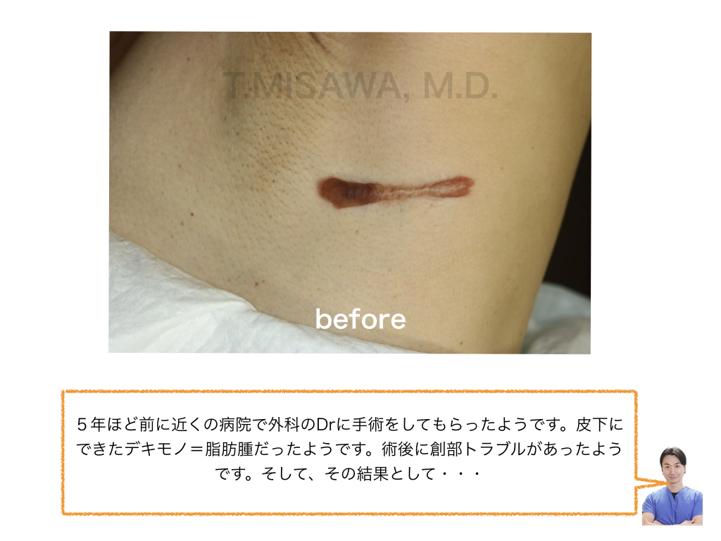 傷跡修正 | 横浜市鶴見の形成・美容外科 エムズクリニック