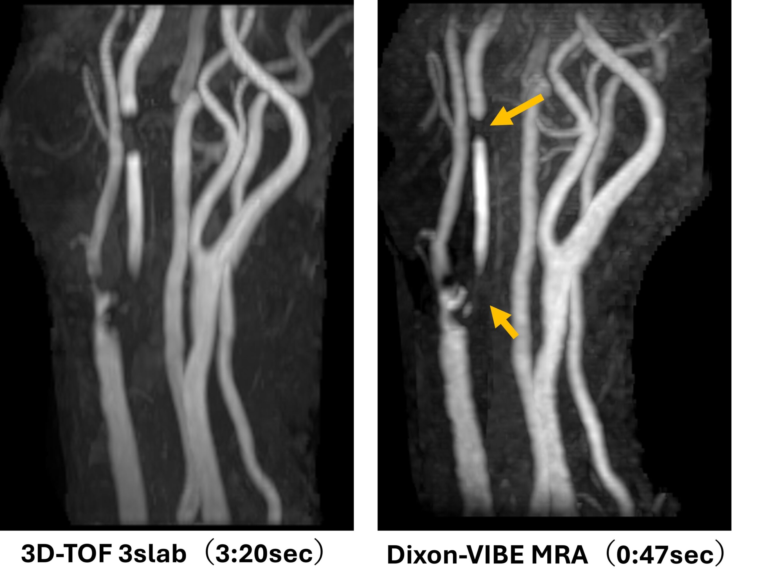 古い装置でもあきらめない！？頭頚部MRA時短撮像 | MRIfan.net