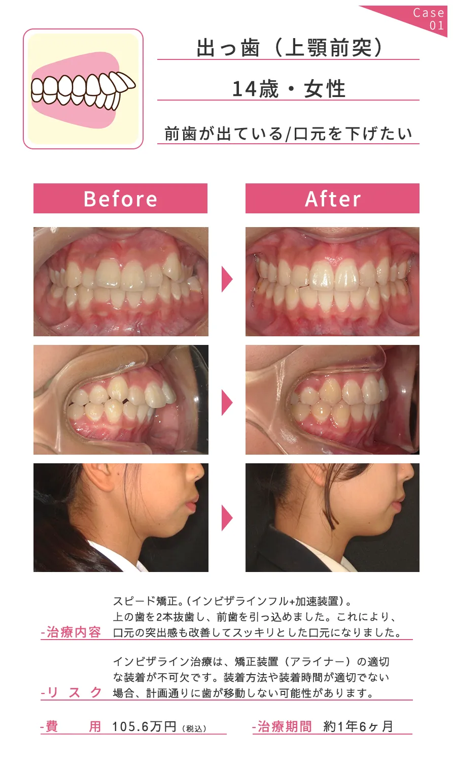 矯正歯科 (インビザライン、マウスピース矯正)｜ダイヤモンドドクター