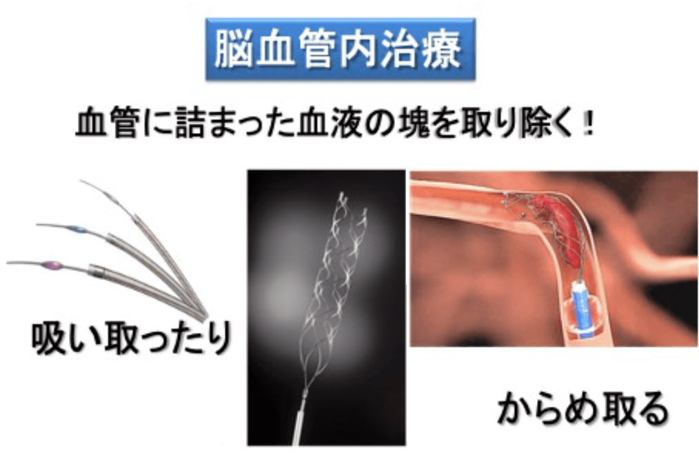 脳血管内治療センター | 医療法人健裕会 永冨脳神経外科病院 脳卒中