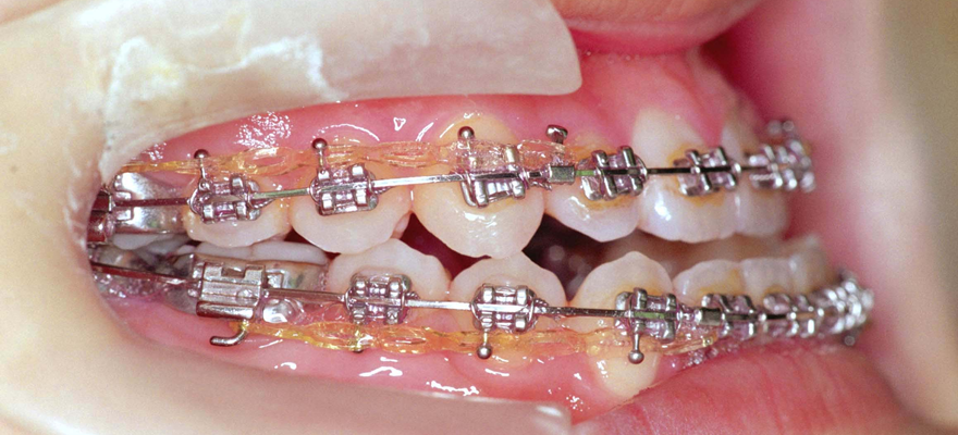 矯正治療について｜北九州市八幡西区のながやま矯正歯科クリニック