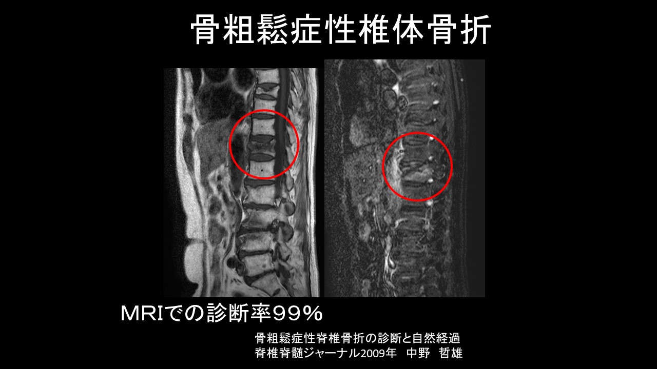 骨粗鬆症性椎体骨折（OVF:osteoporotic vertebral fracture）について