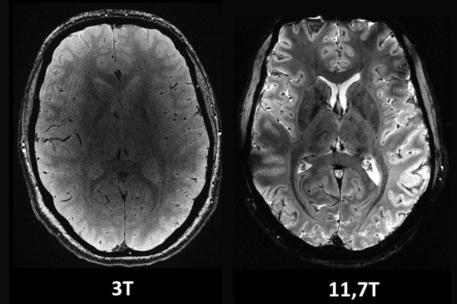 脳が鮮明に見える！世界最強の磁束密度で脳をスキャンするMRI