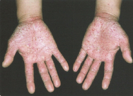 掌蹠膿疱症の悩み｜西宮市の皮膚科｜西宮北口駅スグのねもと皮フ科