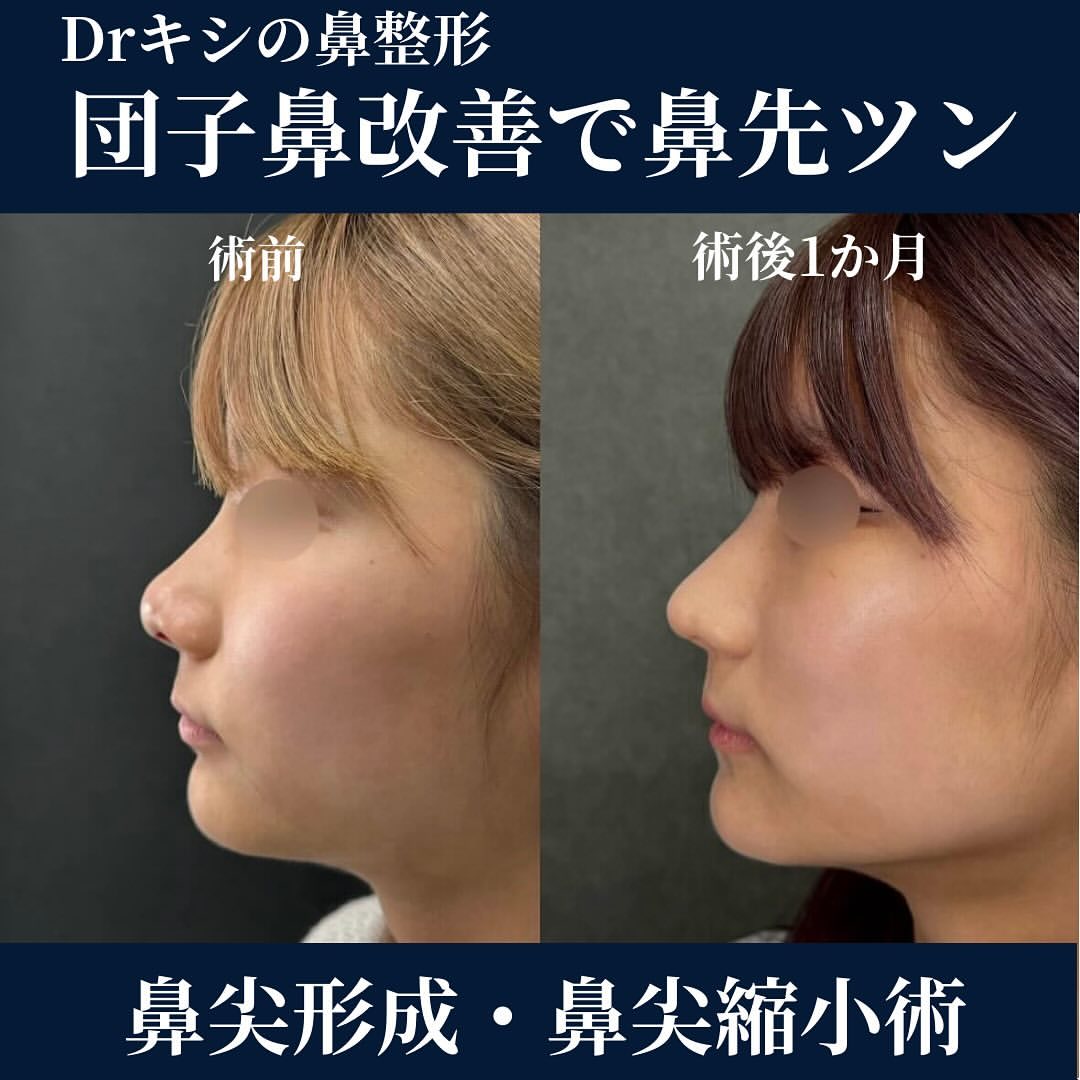 隆鼻術(鼻のヒアルロン酸注入)なら広島・京都・東京錦糸町・神戸・小倉