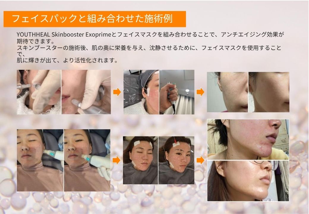 ユースヒール（キャビア注射）で目覚めるハリとツヤ｜NERO DOCTOR