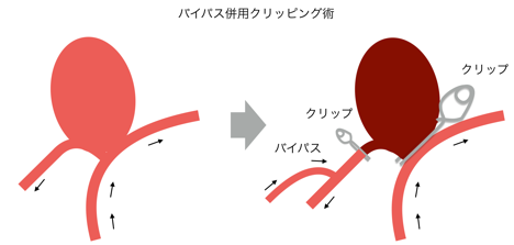 巨大脳動脈瘤 | 脳神経外科 京都大学医学部附属病院