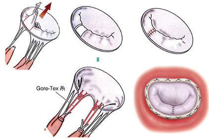 心臓弁膜症の治療・手術 - ニューハート・ワタナベ国際病院