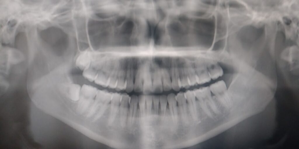 当院の衛生士さんの智歯抜歯しました！ | 日航ビル歯科室｜親知らず