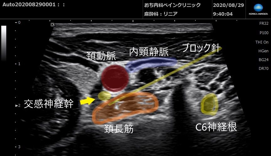 星状神経節ブロック｜自律神経失調症｜頭痛｜顔面帯状疱疹｜おち内科
