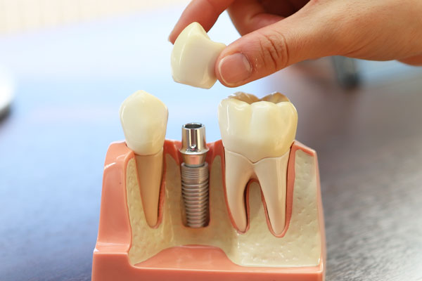 インプラント治療 | 大木歯科・矯正歯科 四日市