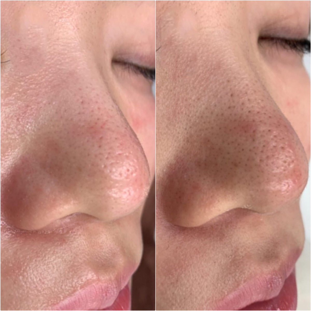 ハイドラフェイシャルは毛穴が広がる？毛穴汚れを自己流で取り除く