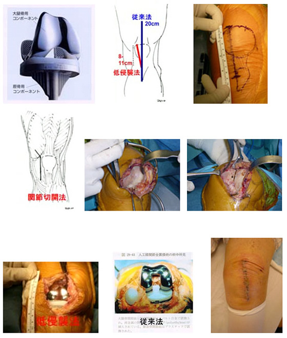 膝関節 | JCHO大阪病院（旧大阪厚生年金病院） | 地域医療機能推進機構