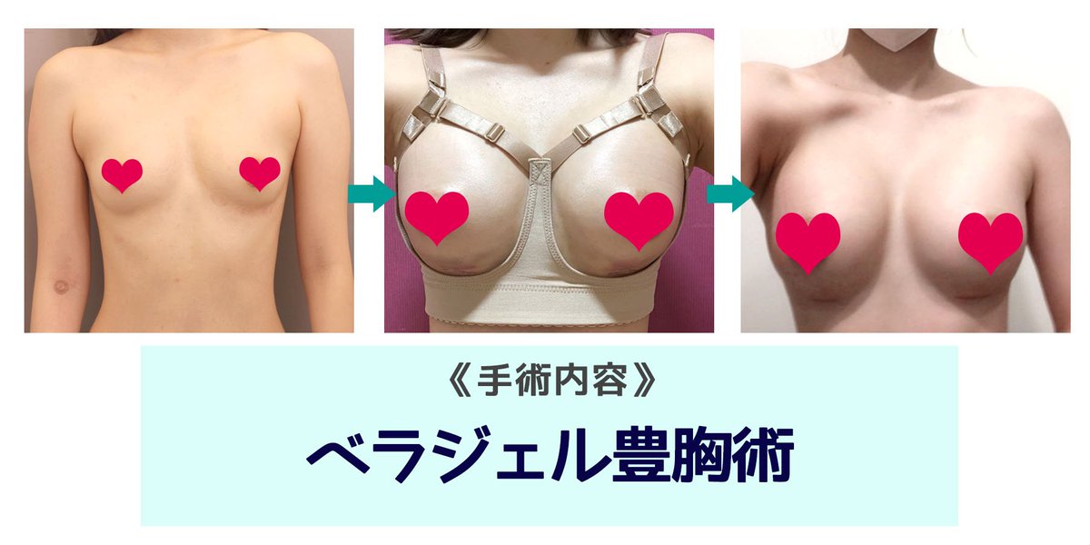 韓国整形・韓国美容整形】 ベラジェル豊胸術の症例写真とレビューです