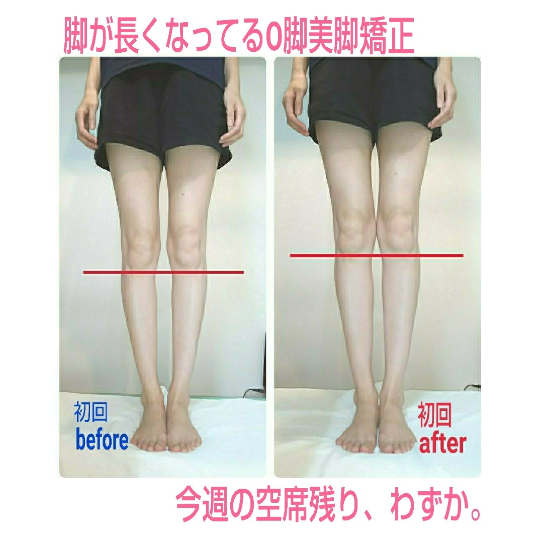 脚が長くなってるO脚美脚矯正に予約殺到中⭐️骨盤矯正付き⭐️満席