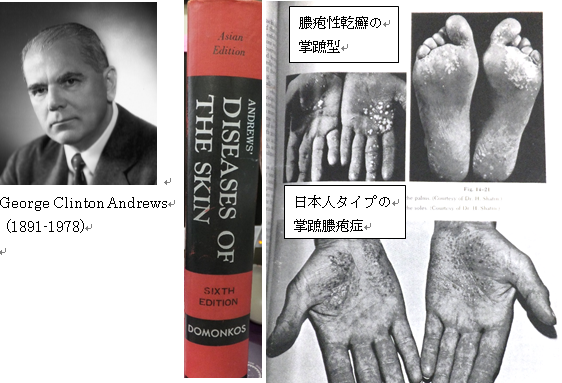 掌蹠膿疱症とは | 掌蹠膿疱症コミュニティのサイト