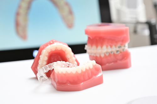 歯列矯正における新しい技術 マウスピース型（アライナー型）装置