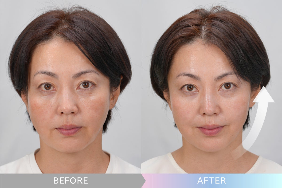 MYTREX】美顔器3台分の機能をひとつに！エイジングケア*に特化した美顔