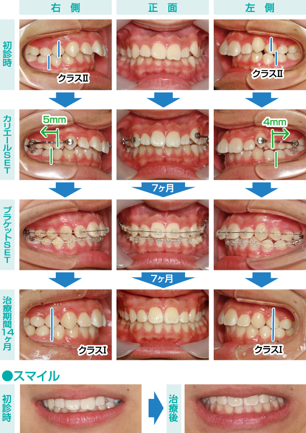 Vol.146 カリエールを用いた非抜歯矯正治療 No.4 | ぷれすしーどWEB