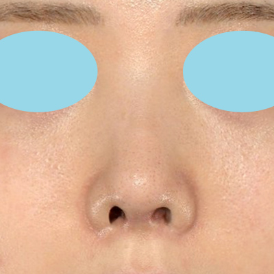 20代女性| 鼻先と鼻の穴の改善症例 | 新宿ラクル美容外科クリニック