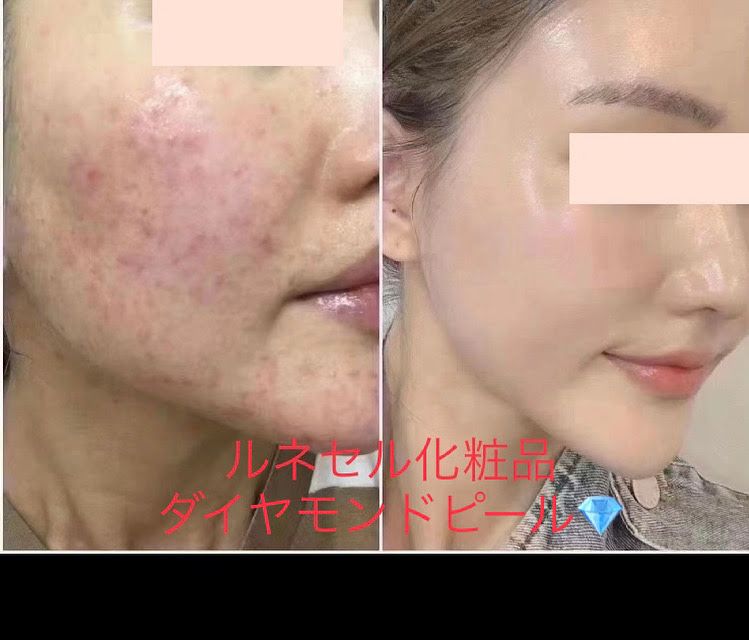 ルネセルダイヤモンドピール施術＋基礎化粧品9種類お持ち帰り-ルネセル