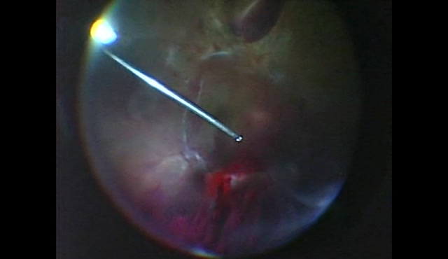 小切開硝子体手術 入門! ―これだけわかれば始められる― | iseminar.net