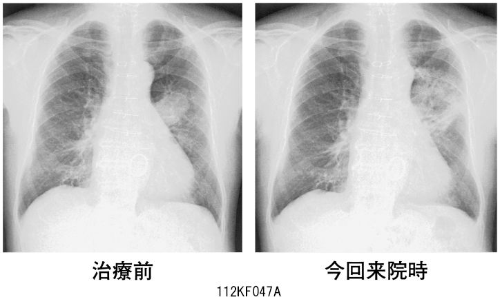 112F47 | 医原性・化学物質による肺障害 国試 | テコプラ