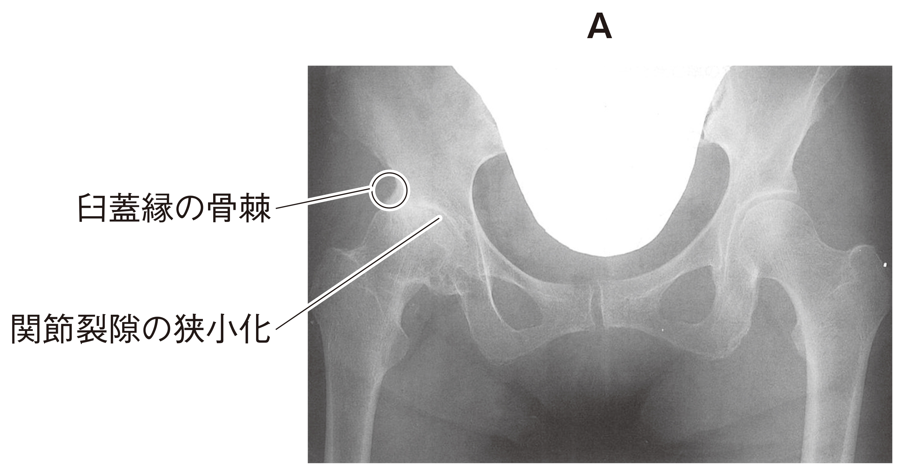 96G100 | 変形性股関節症 国試 | テコプラ
