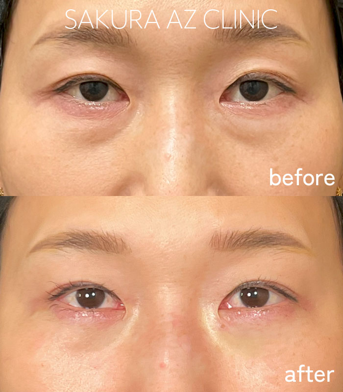 サクラアズ 目の下のクマ・たるみ取り｜大阪心斎橋の美容皮膚科[サクラ