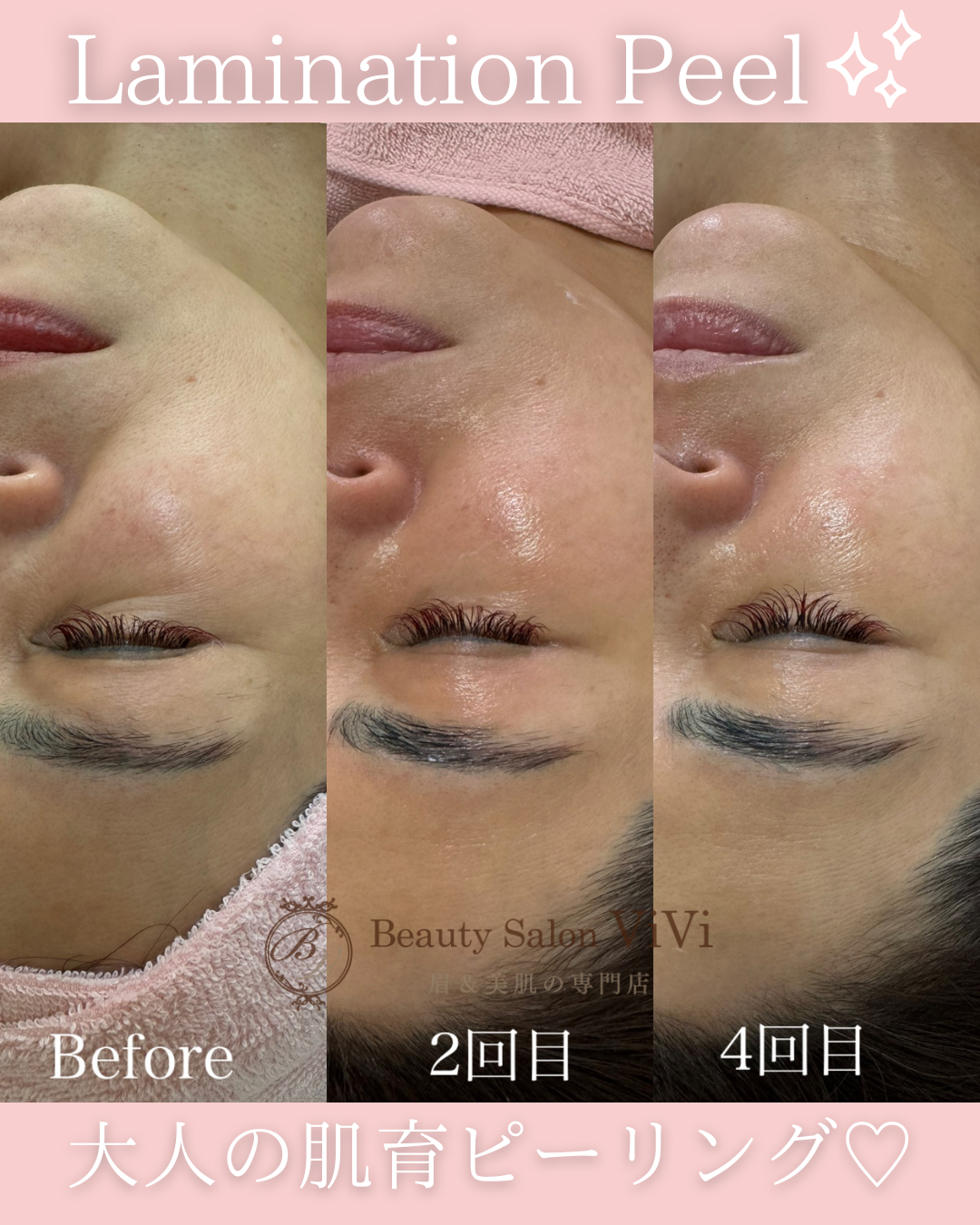 ラミネーションピール回数重ねた経過 - フェイシャルエステ・毛穴洗浄
