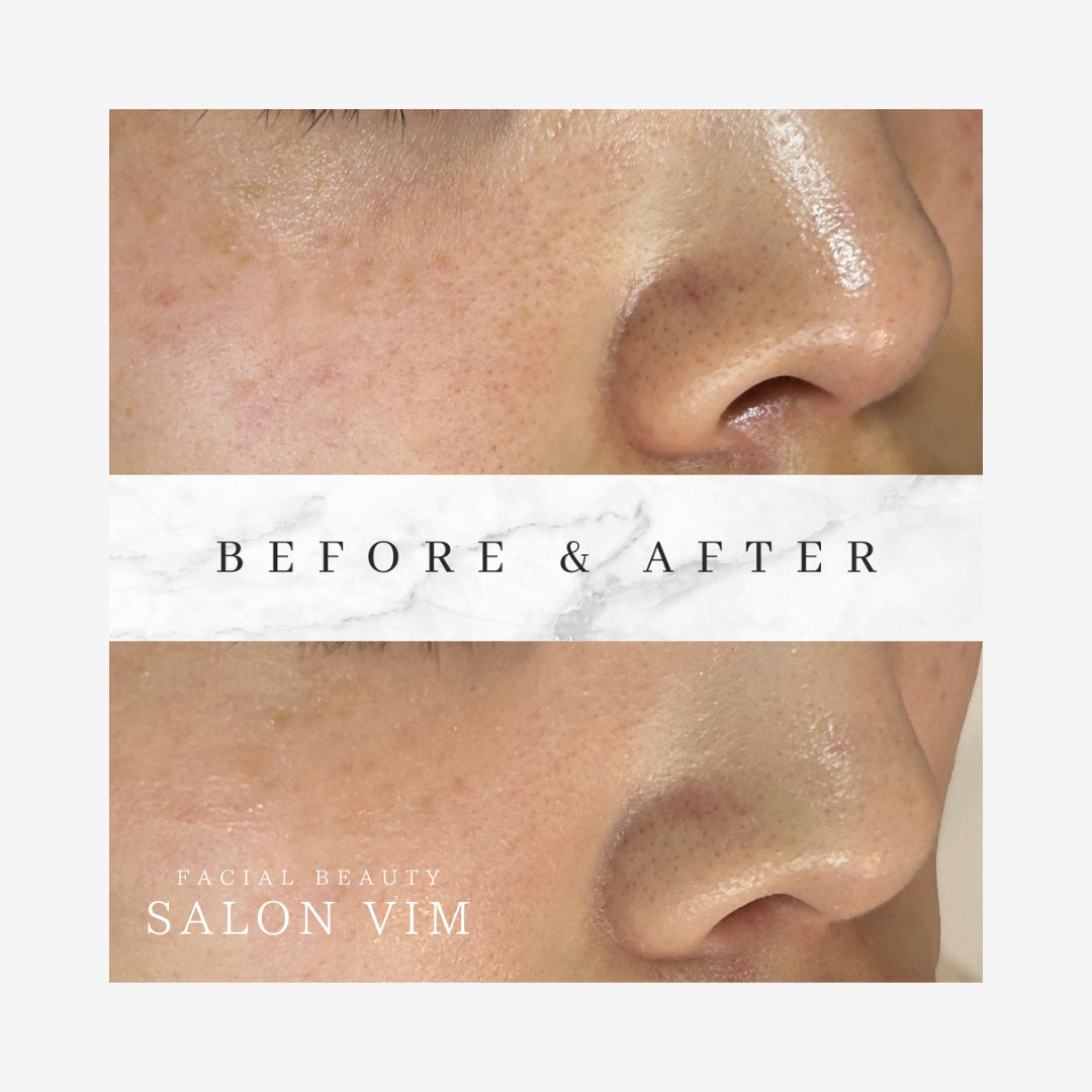 毛穴洗浄・ハイドラ｜神戸元町・三宮のエステサロン「SALON VIM