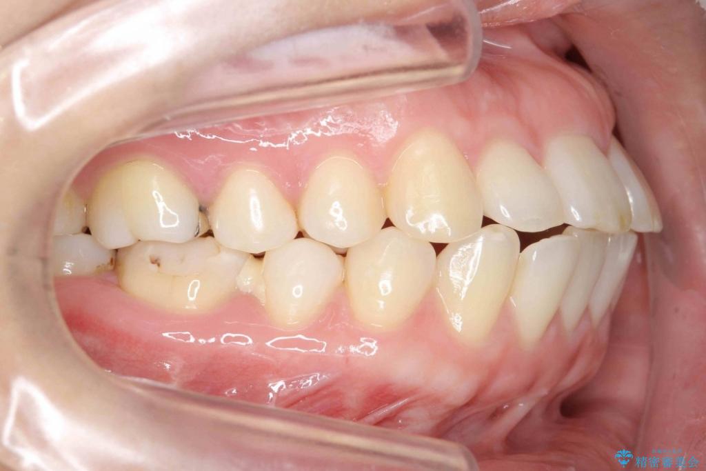 再矯正 非抜歯矯正の仕上がりに不満｜（医）精密審美会