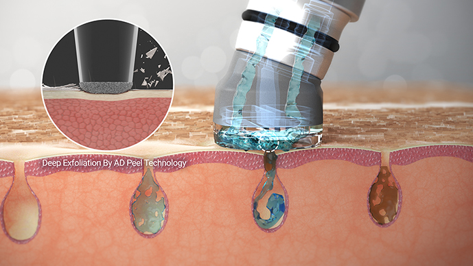 ハイドラブースター』による施術開始 | スキンフィニティクリニック