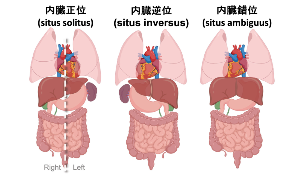右胸心とは? | 心電図.com
