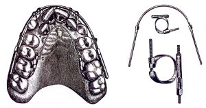 エッジワイズ法の歴史」について - 渋谷矯正歯科グループ - 全国11院