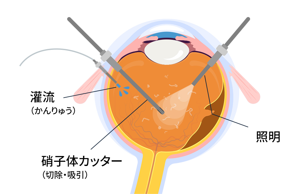 日帰り網膜硝子体手術 | 下田眼科