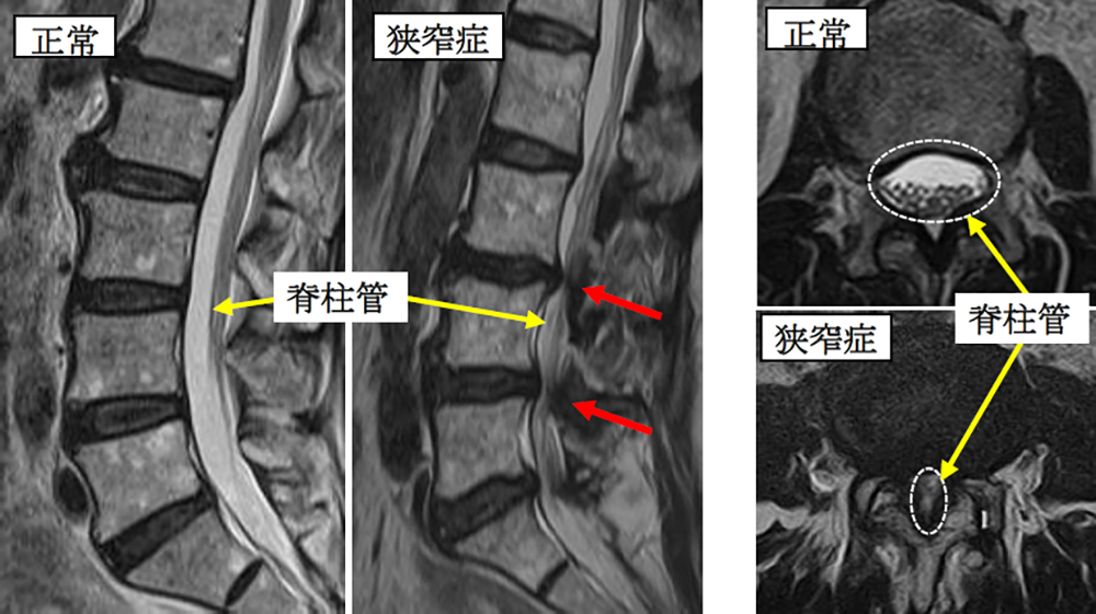 脊椎脊髄疾患について | 東京脊椎脊髄病センター | 苑田第三病院