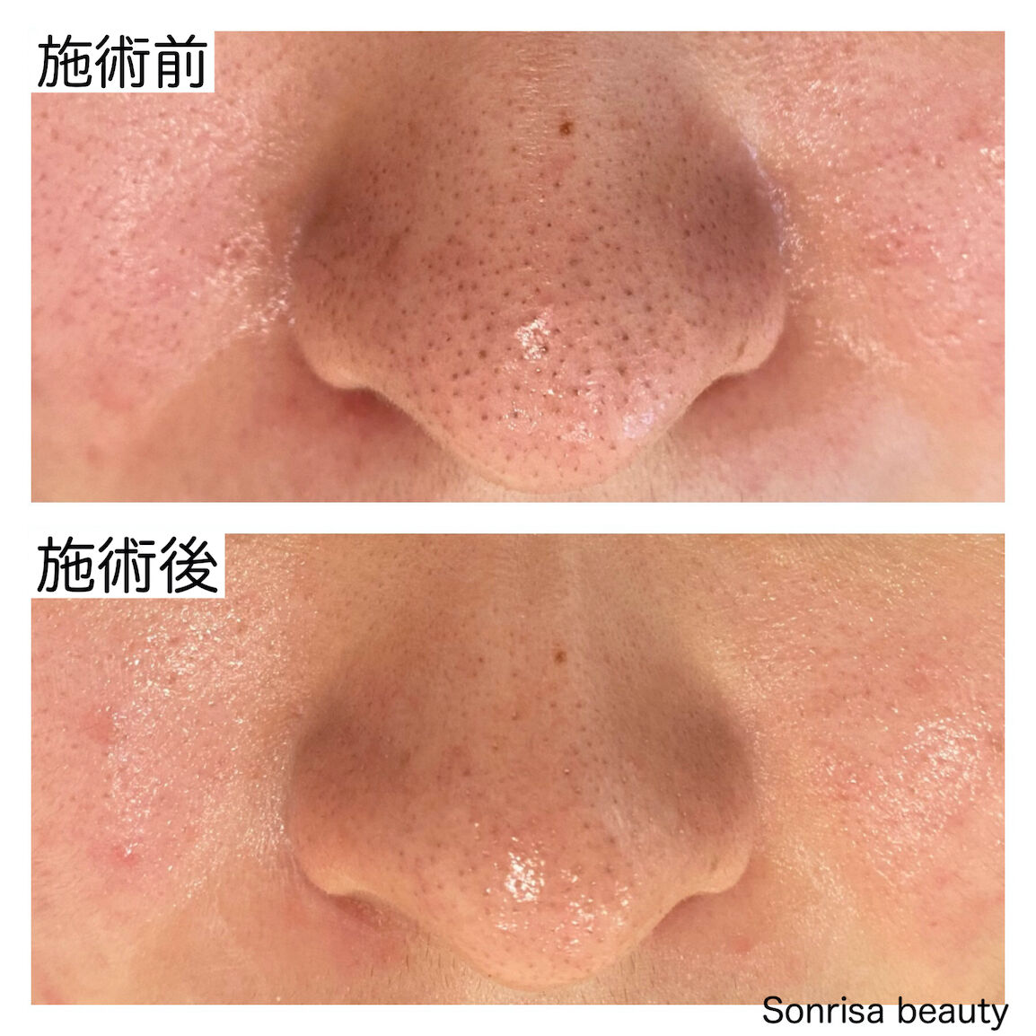 専用ハーブピーリング剥離無し 10回分（11月11日から2月20日の間発送