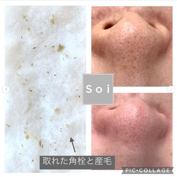 毛穴の黒ずみケアのミストが登場！ | 脱毛サロンSoi