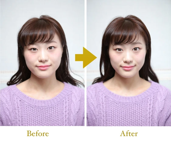 小顔矯正｜名古屋の美容鍼はソアン上前津治療院