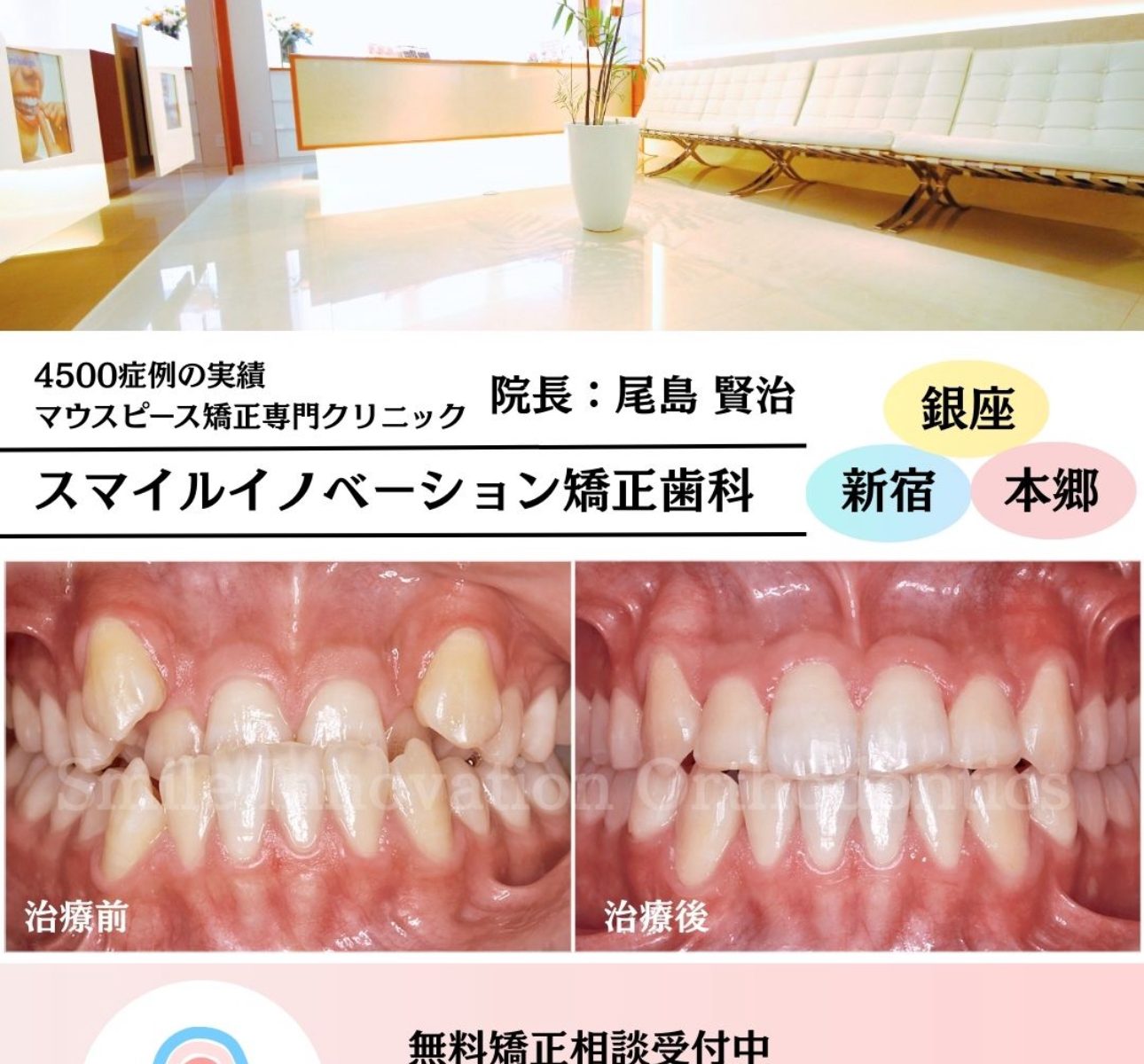 反対咬合の非抜歯によるアライナー矯正治療の解説 – インビザライン