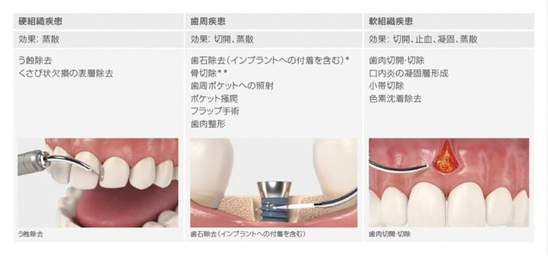 レーザー治療 - 箕面市の歯医者「うえさか歯科」。桜井駅徒歩7分、19時