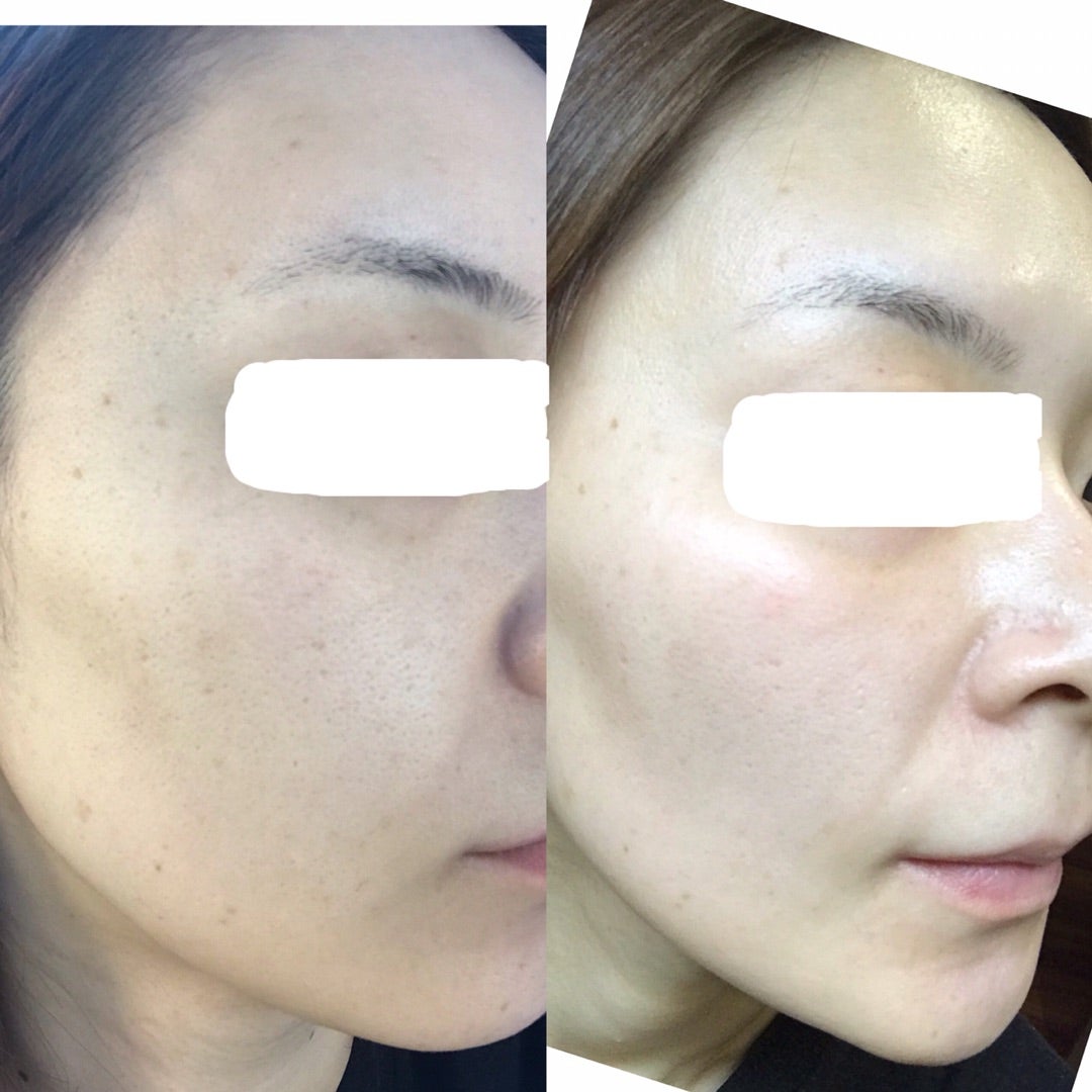 シャルムボーの『整形パック‼️』 CO2パック✨ | 京都・宇治・城陽