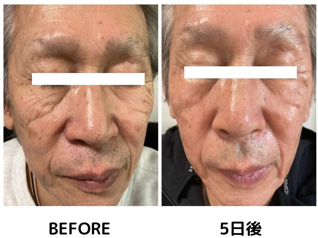 ☆お肌を蘇らせる！ゼオスキンのARナイトリペアピーリング☆ | あゆみ