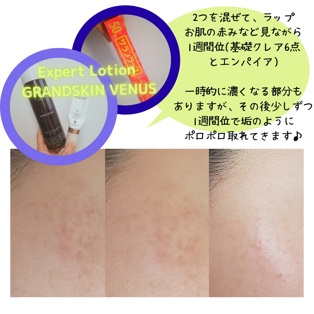 シミ が ぽろぽろ♡グランスキンヴィーナス♪シミ、肝斑、そばかす